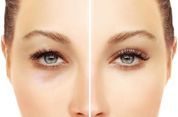 <span class="speciality_title">Blepharoplasty</span>