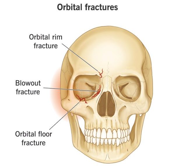 <span class="speciality_title">Reconstruction of Blow-Out Fractures</span>