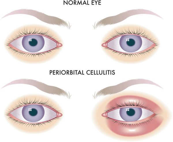 <span class="speciality_title">Orbital Cellulitis</span>
