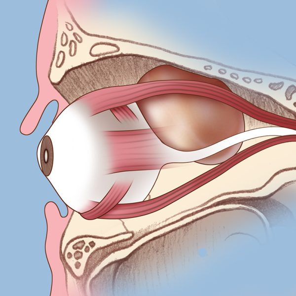 <span class="speciality_title">Orbital Tumours</span>