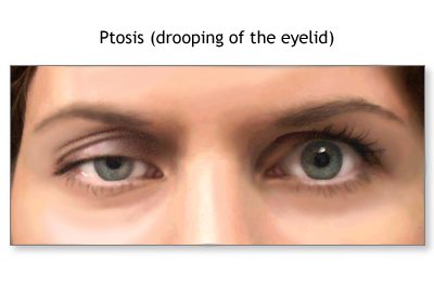 <span class="speciality_title">Ptosis Surgery</span>