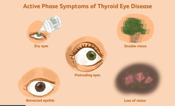<span class="speciality_title">Thyroid Eye Disease (TED)</span>